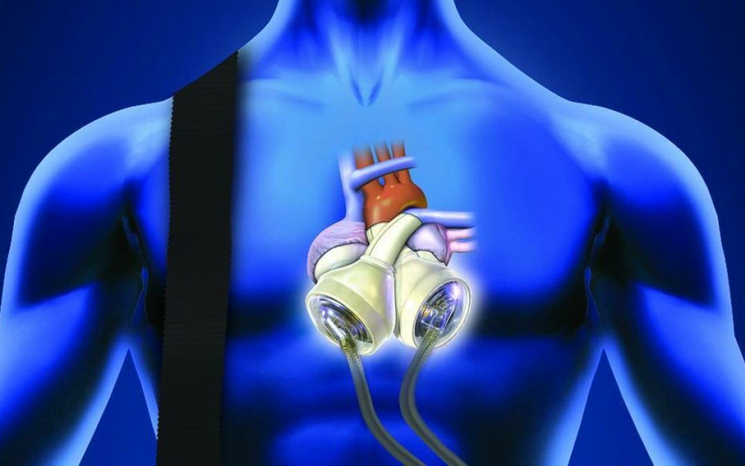 Man Lived Without A Heart For 555 Days, Carrying An Artificial One In His Rucksack