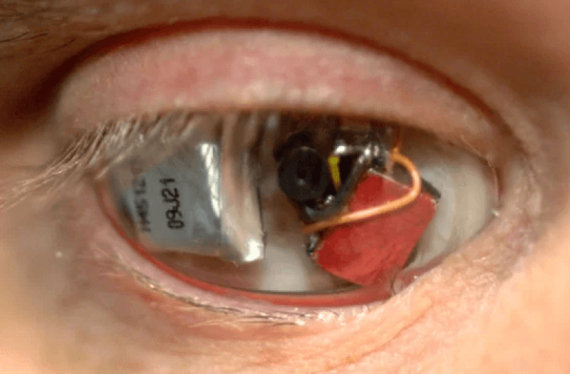 A Man Who Lost An Eye Reveals Why He Replaced It With A Wireless Camera